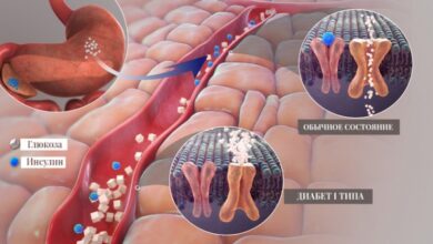 Photo of Диабет 1 типа: не смертельно, хотя и не лечится